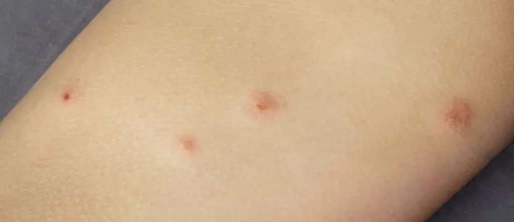 Укусы тараканов