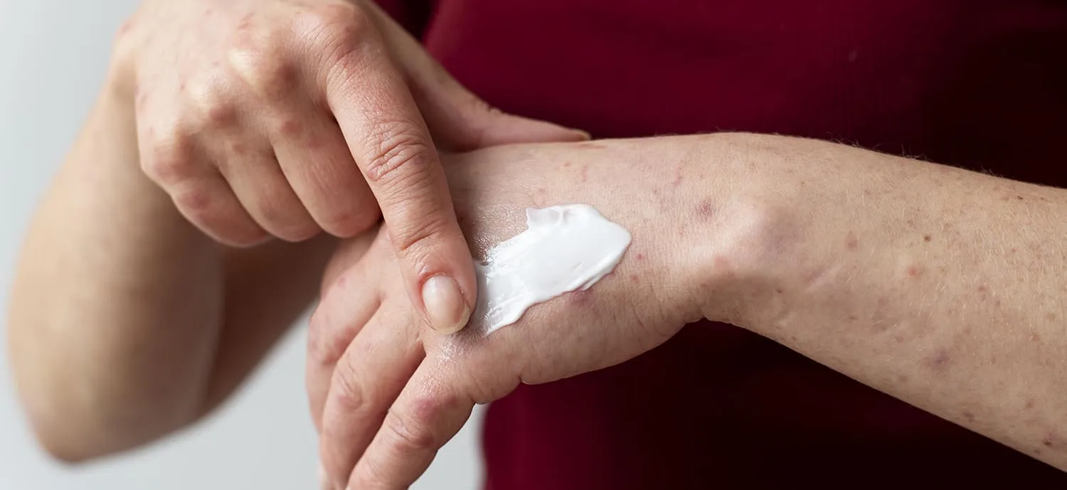 Помощь при укусах тараканов