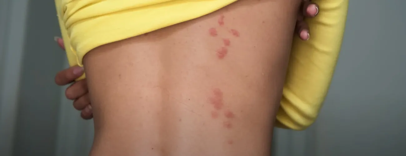 Признаки клопов: укусы на теле