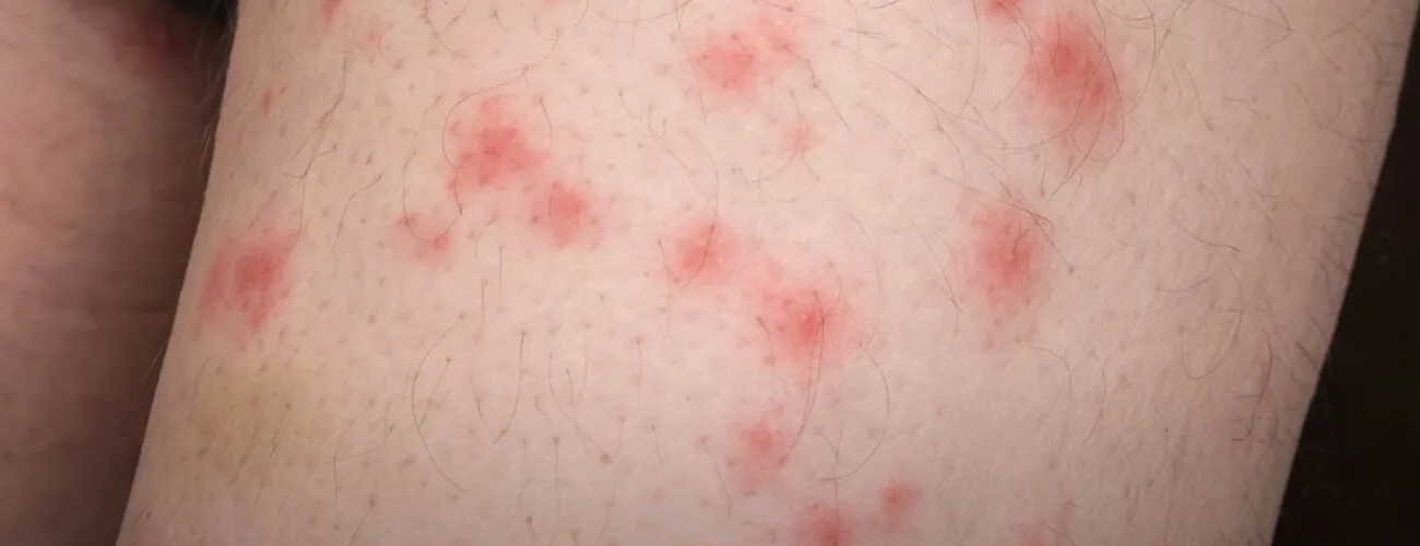 Укусы бельевых клопов Укусы постельных клопов