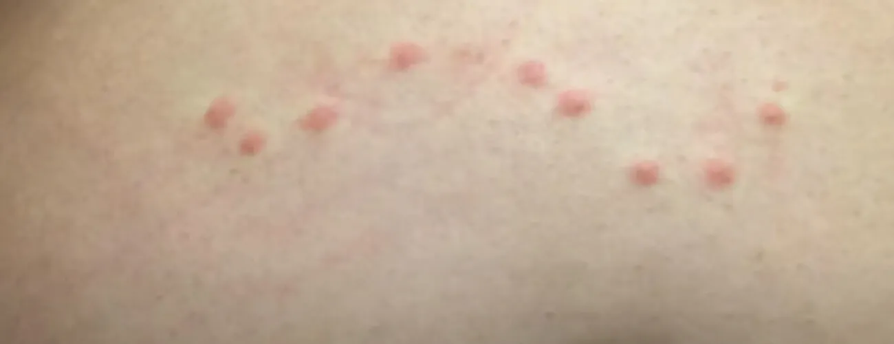 Укусы постельного клопа на коже Укусы бельевого клопа на коже