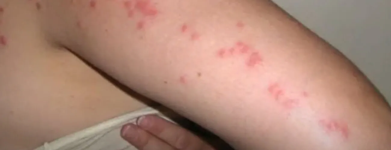 Укусы бельевых клопов на руке Укусы постельных клопов на руке