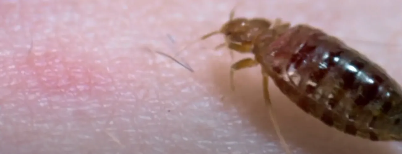 Покраснение после укуса клопа Свежий укус постельного клопа