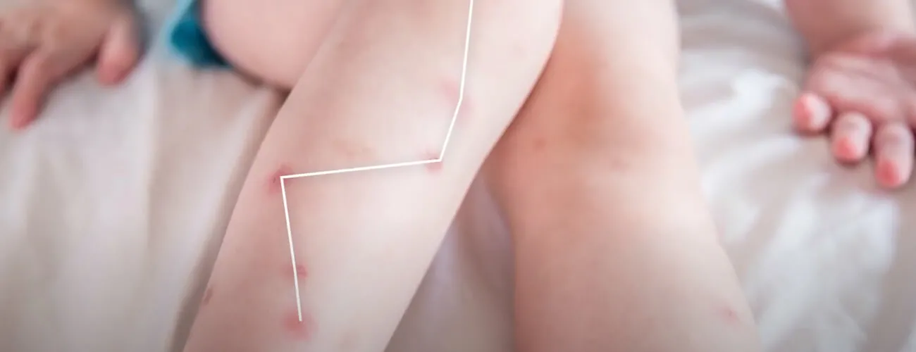 Укусы бельевых клопов на ноге ребенка Укусы постельных клопов на ноге ребенка