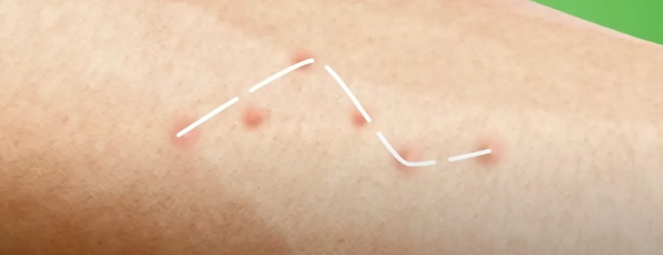 Укусы бельевых клопов часто располагаются зигзагами Укусы постельных клопов часто располагаются зигзагами