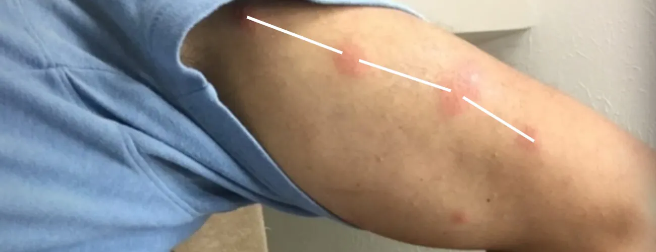 Цепочка укусов бельевого клопа по прямой линии Укусы постельных клопов часто располагаются по прямой линии цепочкой