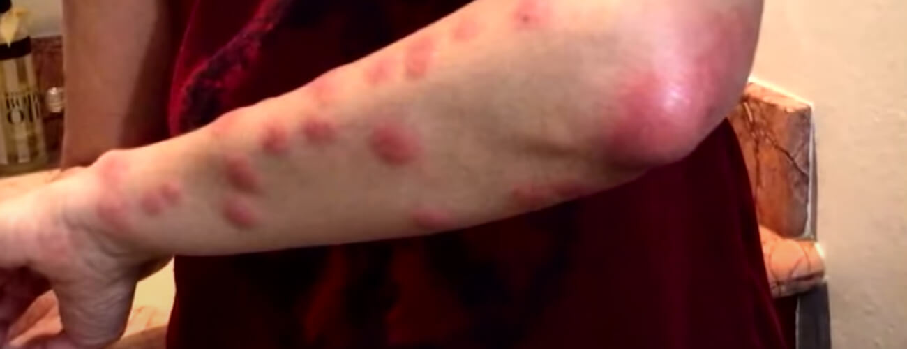 Осложнения после укусов постельных клопов